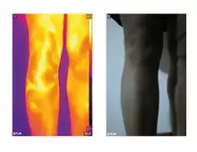 Procesamiento de Imágenes Térmicas para la identificación de Varices en las Piernas